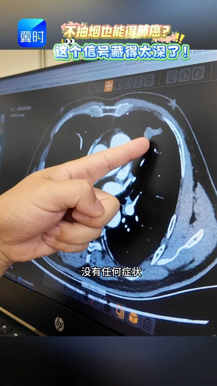 嗓子哑了两周竟然查出肺癌？医生划重点：这三个体表信号，花1分钟自测  #媒体原创 #肺癌 #声音嘶哑 #健康科普